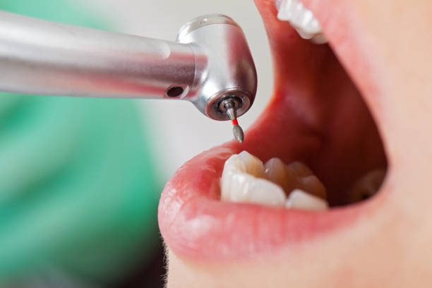 Best Walk-In Emergency Dentist in Union City, IN